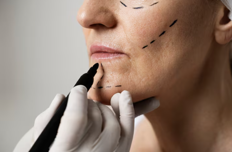 Facial Fat Grafting: Will You Look Younger the More Fat You Add? Why Too Much Can Look Unnatural image 2