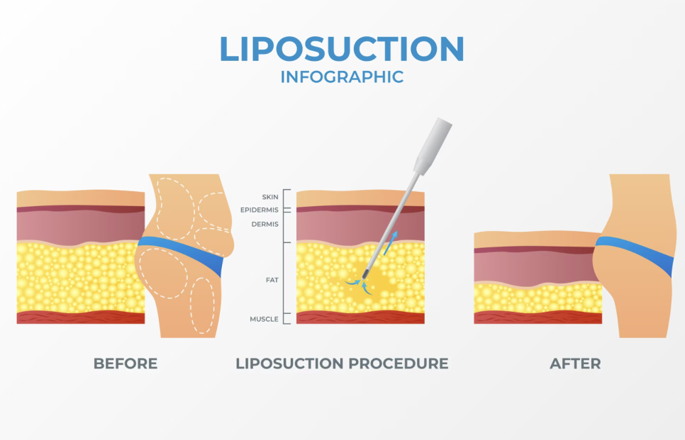 Why Body Shape Analysis Before Leg Liposuction Surgery Is Important image 2
