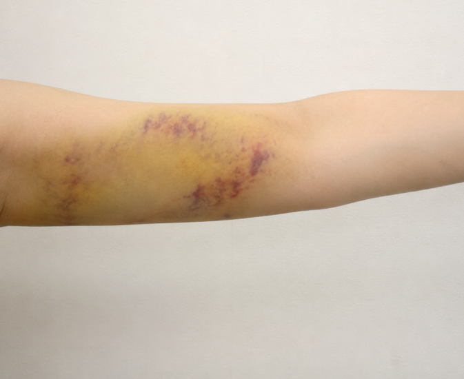 Arm Liposuction Review: A Clear Overview of the Recovery Process and Changes in Contour image 5