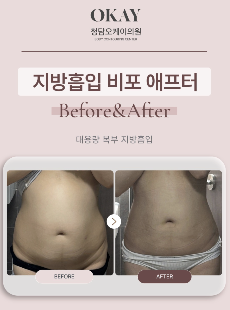 Liposuction Surgery Methods: Things Not Often Covered in Reviews image 4