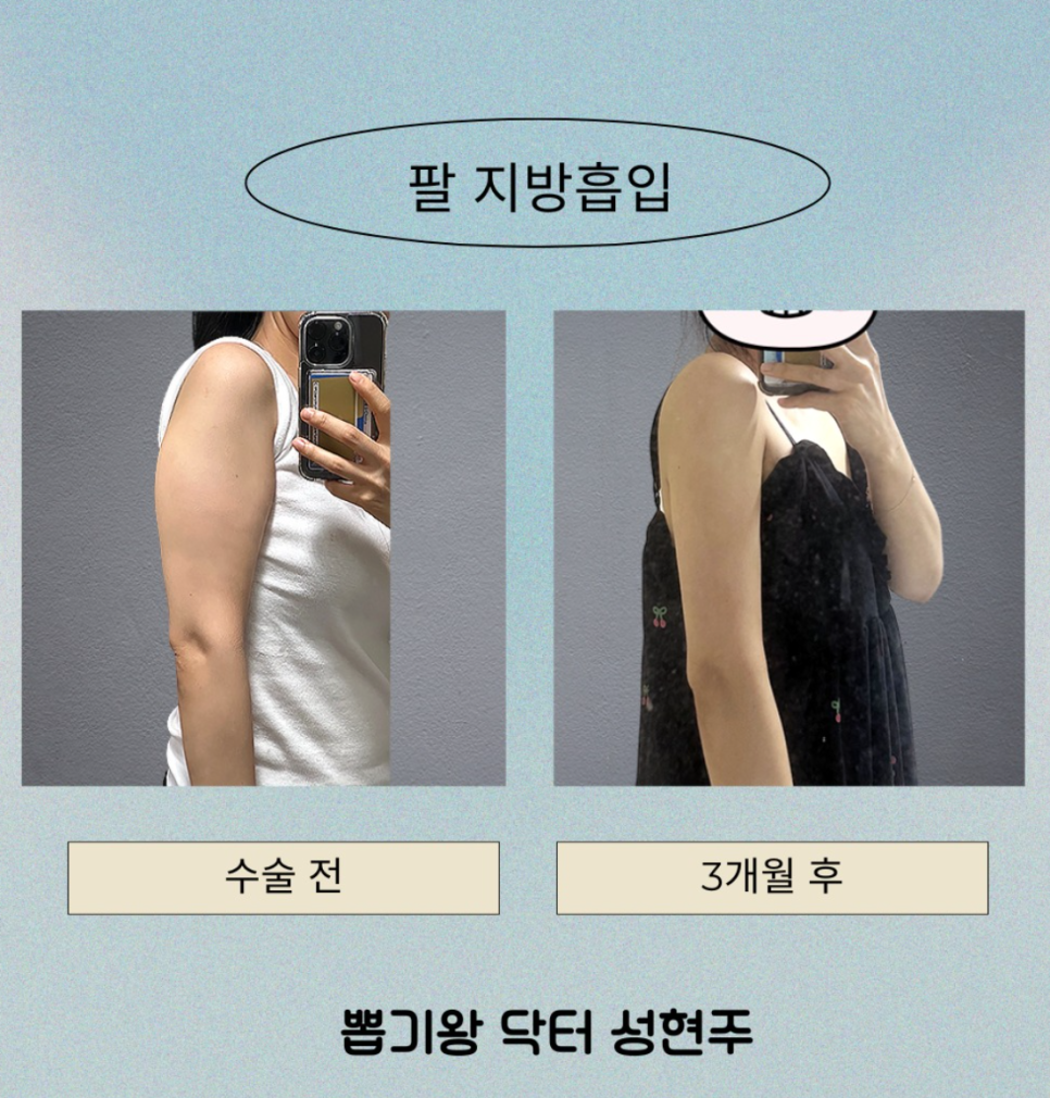 신사역성형외과, 뱃살&middot;팔뚝살 지방흡입으로 얼마나 줄일 수 있을까요? 관련 이미지 7