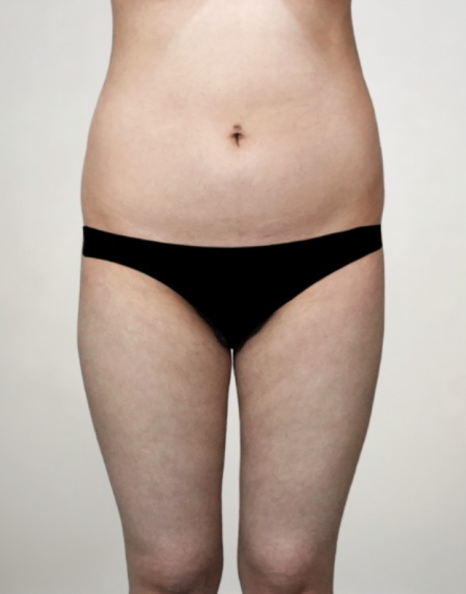 허파고리술가격, 후회하지 않으려면 확인해야 할 4가지 관련 이미지 2