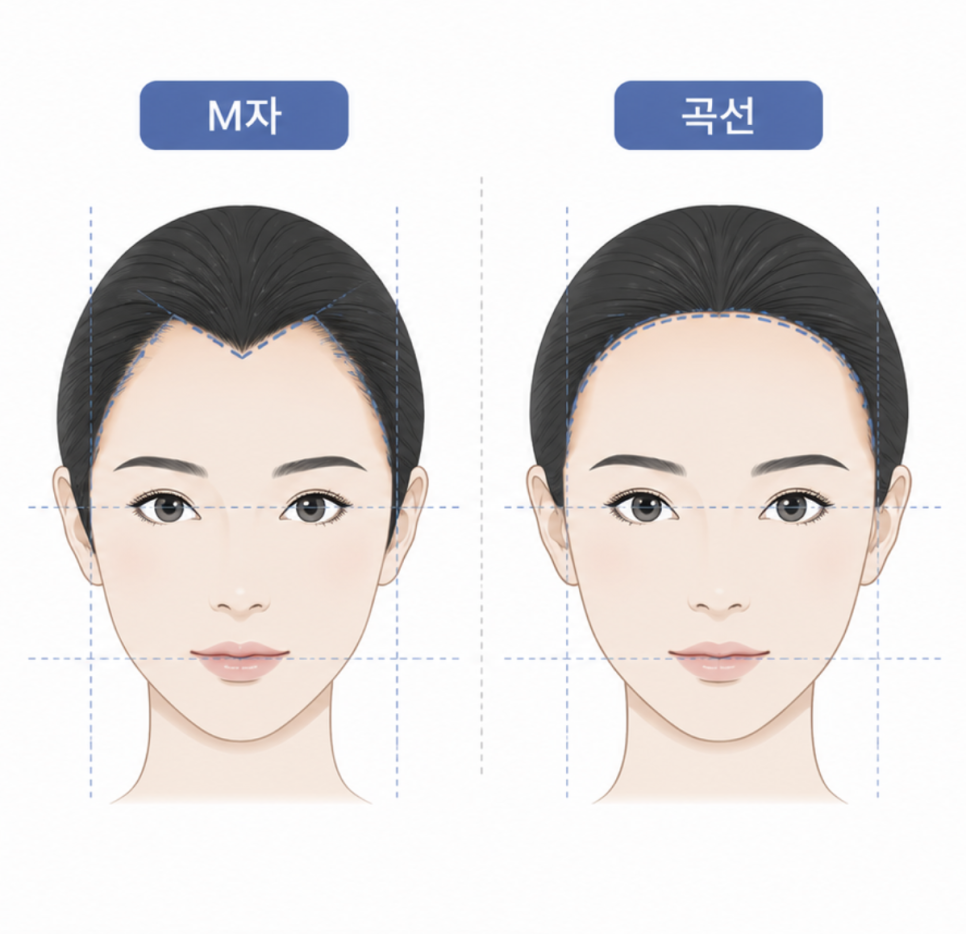 M-Shaped Hairline Hair Transplantation: Why Women Are Seeking It First image 6