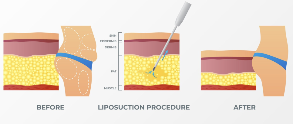 If You’re Looking for a Clinic Skilled in Revision Liposuction, Why You Should Never Simply Undergo Liposuction Again image 7