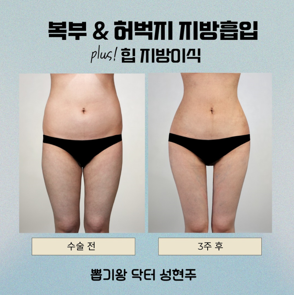 허벅지안쪽지방흡입, 라인이 예뻐지는 시기는 언제부터일까요? 관련 이미지 9