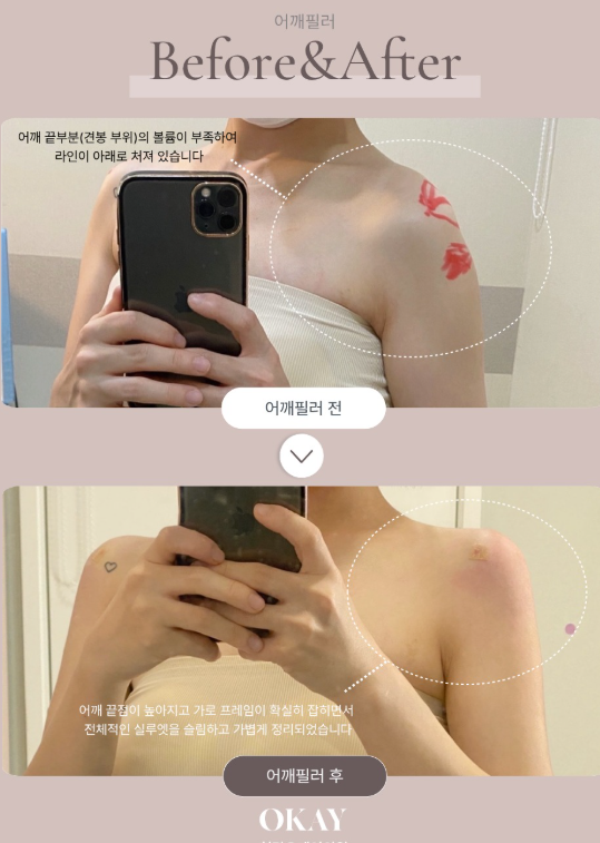 어깨필러, 직각어깨를 원한다면 라인부터 확인해야 하는 이유 관련 이미지 5