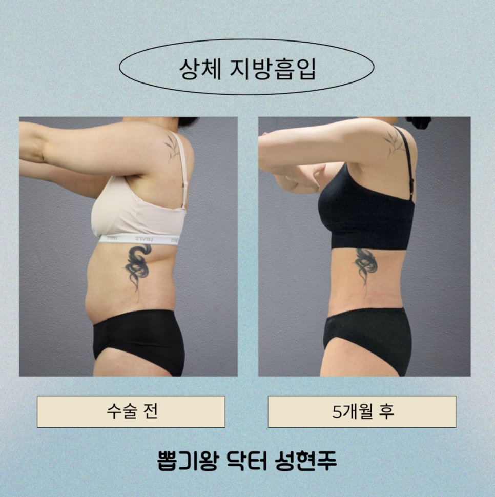팔뚝지방흡입수술비용, 팔뚝 굵기에 따라 달라질 수 있을까요? 관련 이미지 10