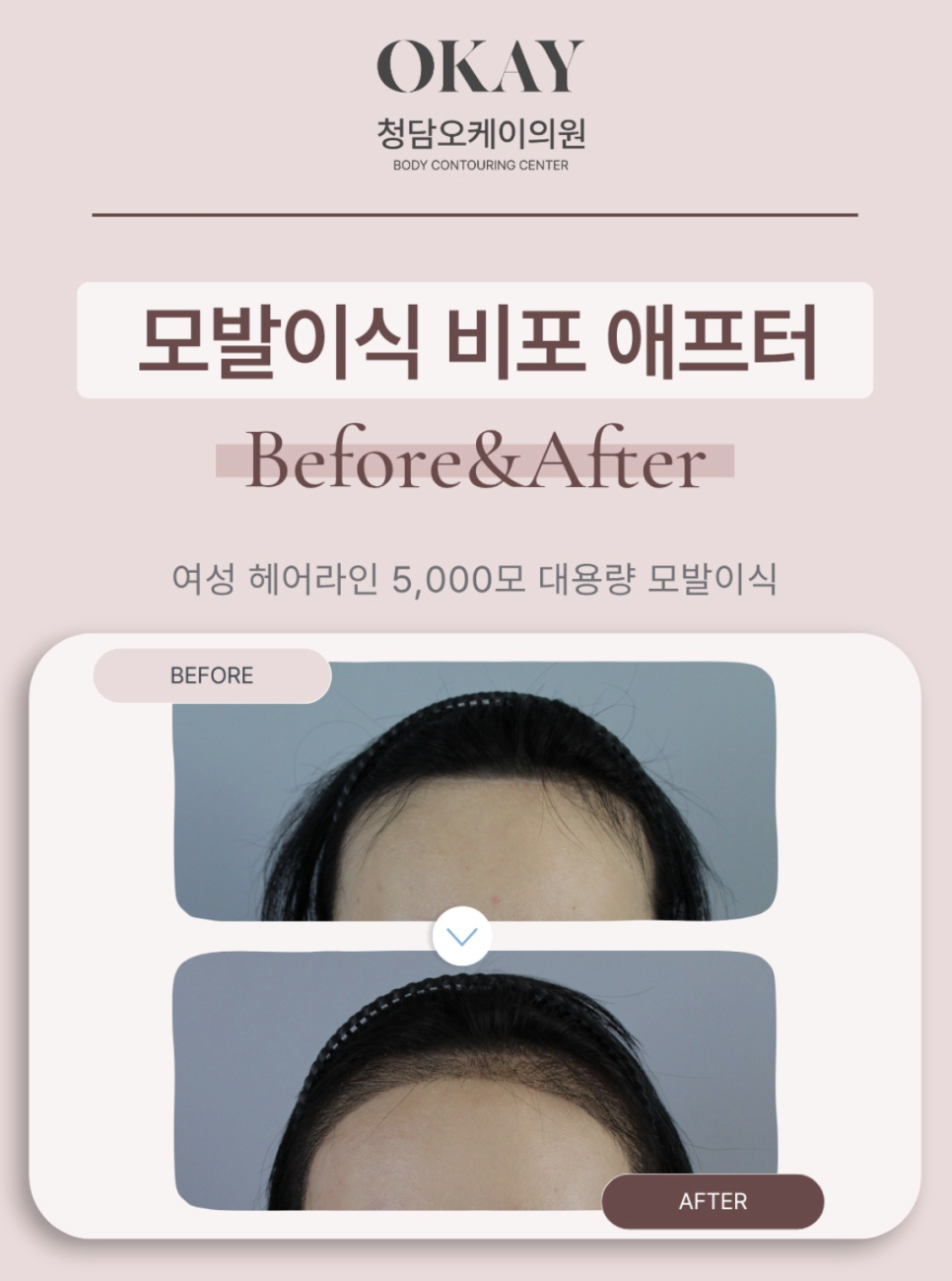 모발이식생착기간, 언제부터 안심해도 될까요? 딱지·운동·모자까지 총정리 관련 이미지 9