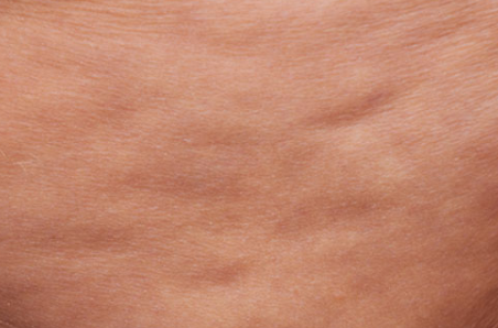 Post-Liposuction Lumpiness Management: Essential Care Tips for Reducing Hardness image 2