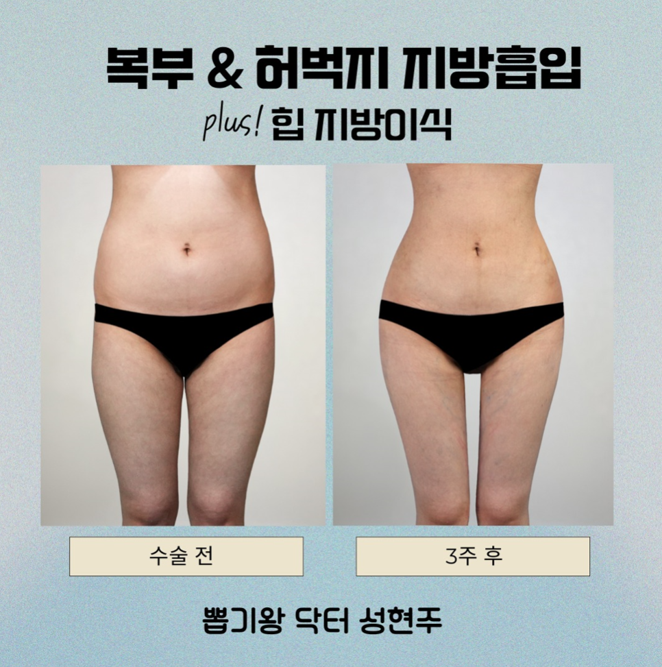 허벅지지방흡입, 효과가 만족도로 이어지는 이유 관련 이미지 4