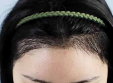 Can Hair Transplant Graft Survival Rates Differ Between Non-Excision and Excision Methods? Comparing Differences in Recovery Management image 12