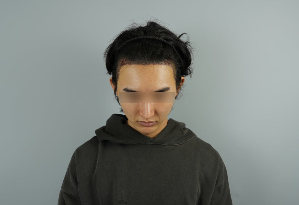 Can Hair Transplant Graft Survival Rates Differ Between Non-Excision and Excision Methods? Comparing Differences in Recovery Management image 3