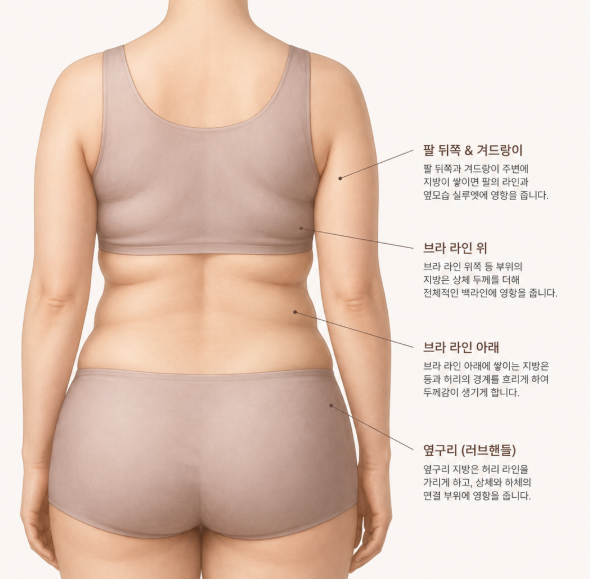 상체지방흡입, 팔뚝·등·옆구리까지 같이 해야 할까요? 관련 이미지 8