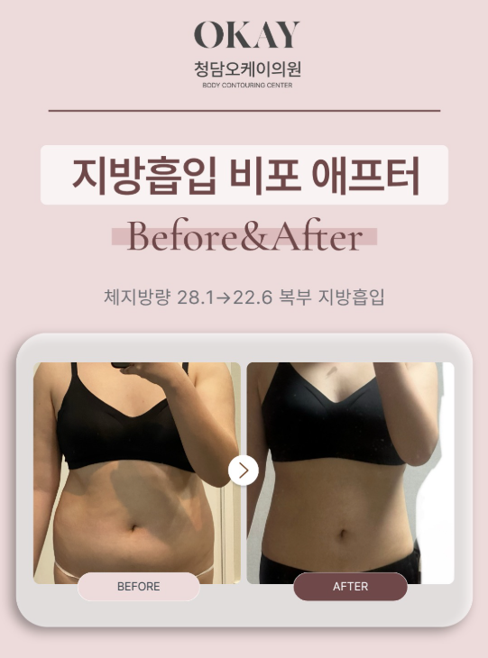 강남성형외과 복부 지방흡입, 슬림한 허리라인은 이렇게 완성됩니다 관련 이미지 9