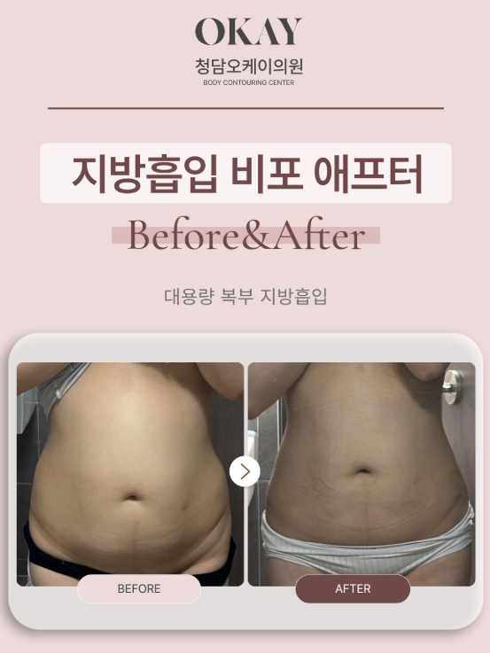 아랫배지방흡입, 유독 뱃살만 안 빠진다면 확인해야 할 것 관련 이미지 7