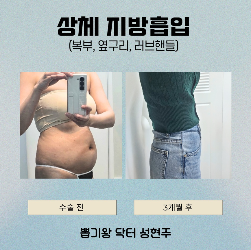Post-Liposuction Lumpiness Management: Essential Care Tips for Reducing Hardness image 11