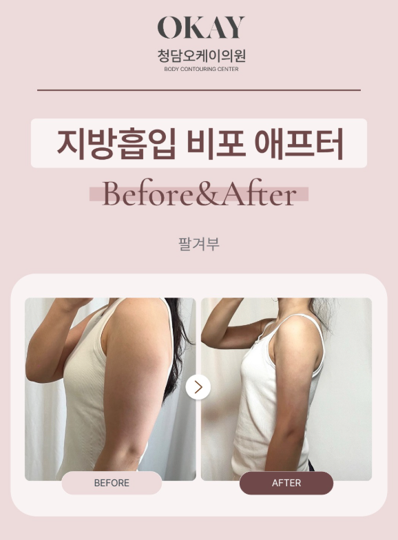 팔지흡 압박복 기간, 언제까지 입어야 할까요? 붓기와 회복기간 총정리 관련 이미지 6
