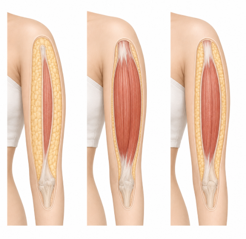 팔뚝 지방추출주사, 지방흡입과 뭐가 다를까요? 효과·비용까지 비교 관련 이미지 5