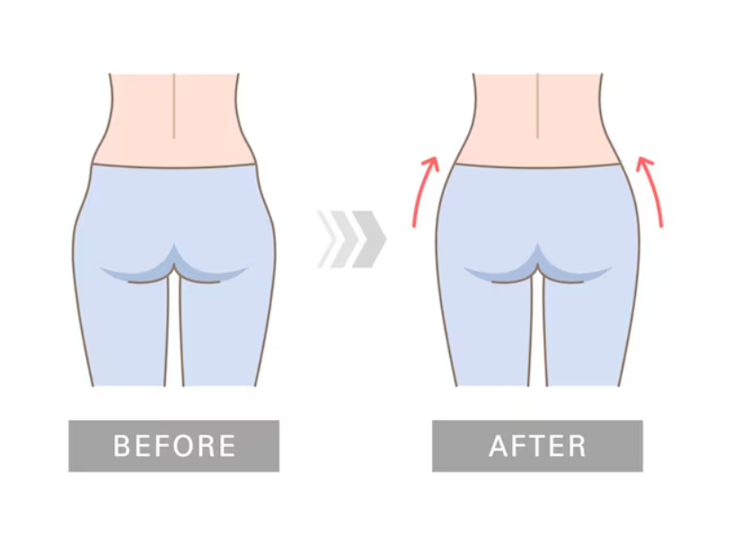 Buttock Fat Grafting: What Makes the Difference in Improving Fat-Graft Retention? image 8