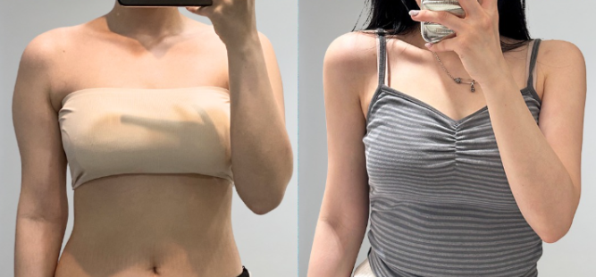 From 2 Weeks to 3 Months After Arm Liposuction: How Does the Arm Contour Change? image 7