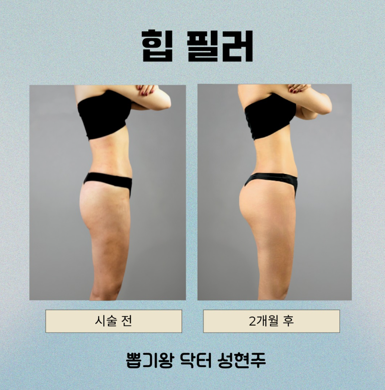 청담동 골반필러 자연스럽게 되는 기준, 과하지 않게 라인 만드는 방법 관련 이미지 3
