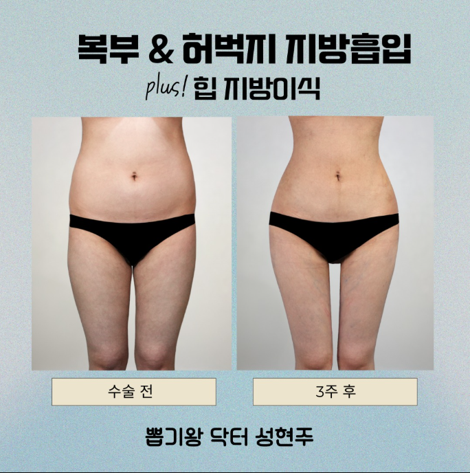 청담동성형외과 지방흡입 부작용 있을까? 수술 전 알아야 할 점 관련 이미지 9