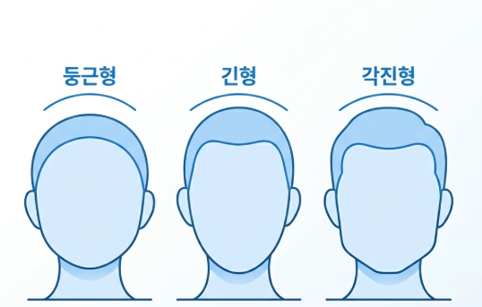 헤어라인모발이식, 이마만 채우면 끝일까요? 관련 이미지 6
