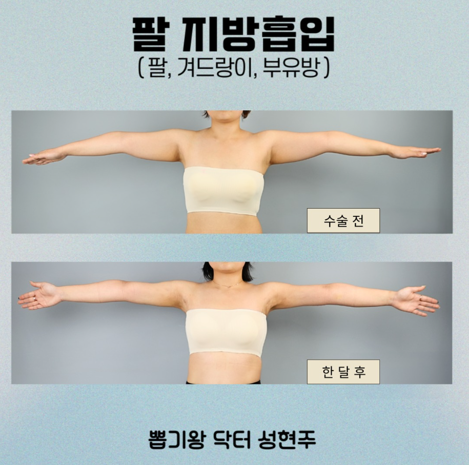 전신지방흡입 어떤 경우에 필요할까? 체형 기준과 수술 방법 설명 관련 이미지 3