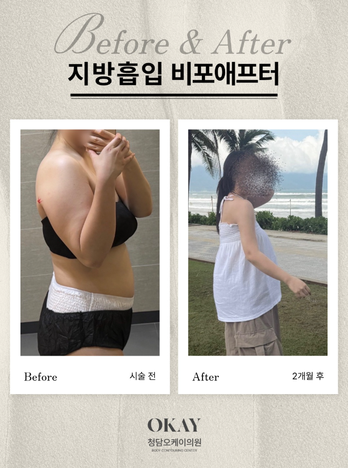 팔지방흡입 후기에서 자주 나오는 부작용 느낌, 왜 생길까요? 관련 이미지 7
