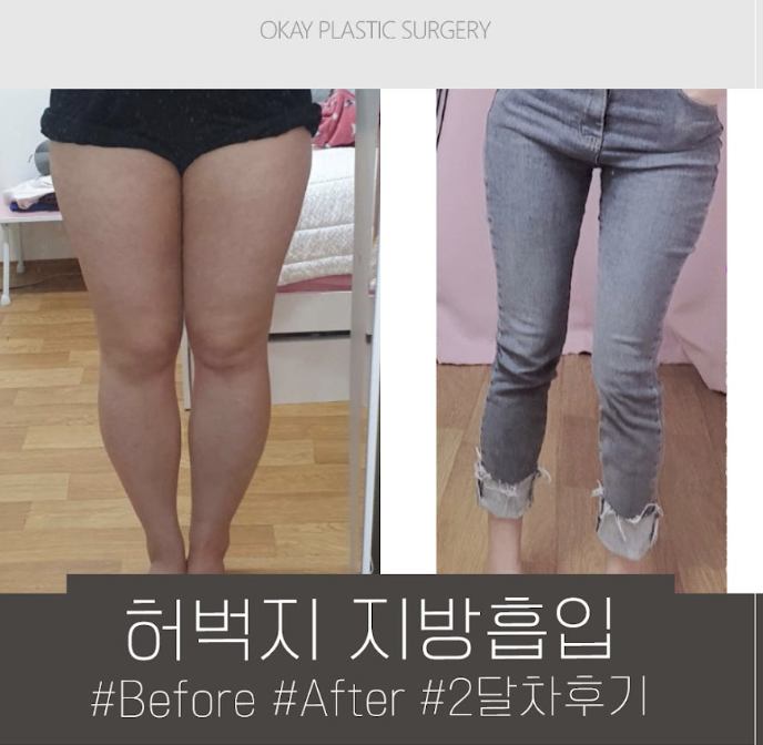 허엉무 지방흡입, 승마살부터 허벅지 안쪽까지 같이 봐야 하는 이유 관련 이미지 9