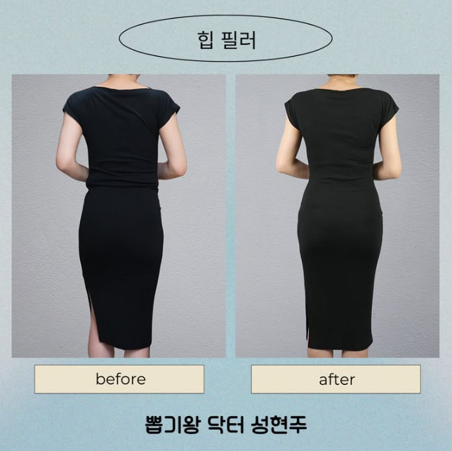 How Long Does Pelvic Filler Last? Body Shape Changes and Effects Explained image 4