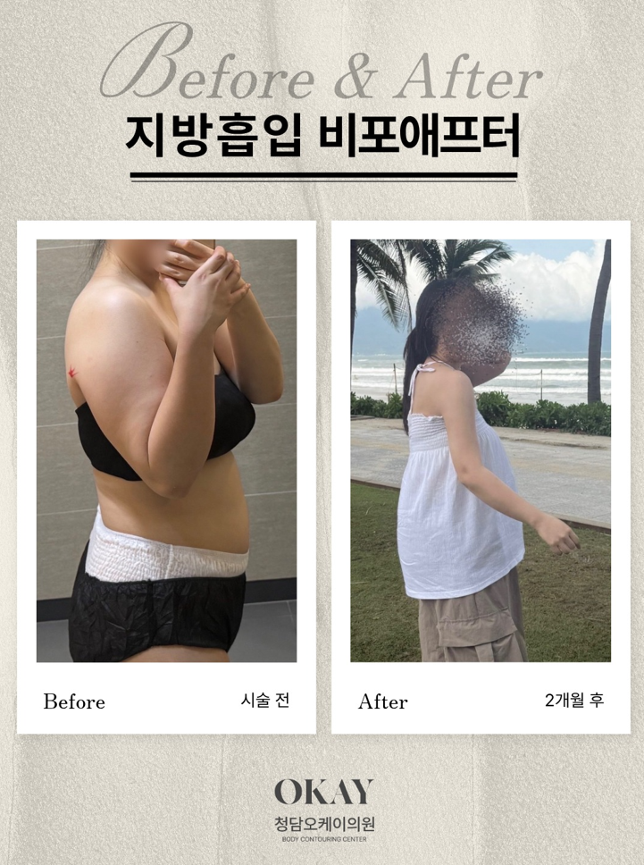 팔지방흡입, 통증은 얼마나 갈까요? 회복 과정 총정리 관련 이미지 6