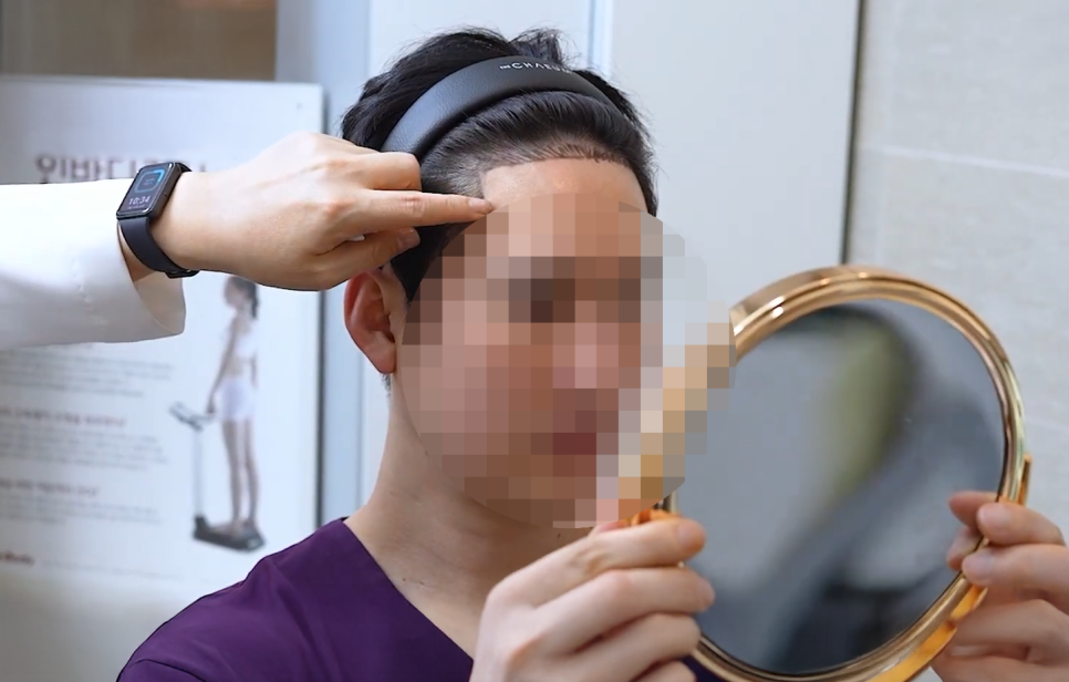 강남 여자앞머리모발이식 생착률 얼마나 될까? 몇모·디자인·통증·가격 정리 관련 이미지 3