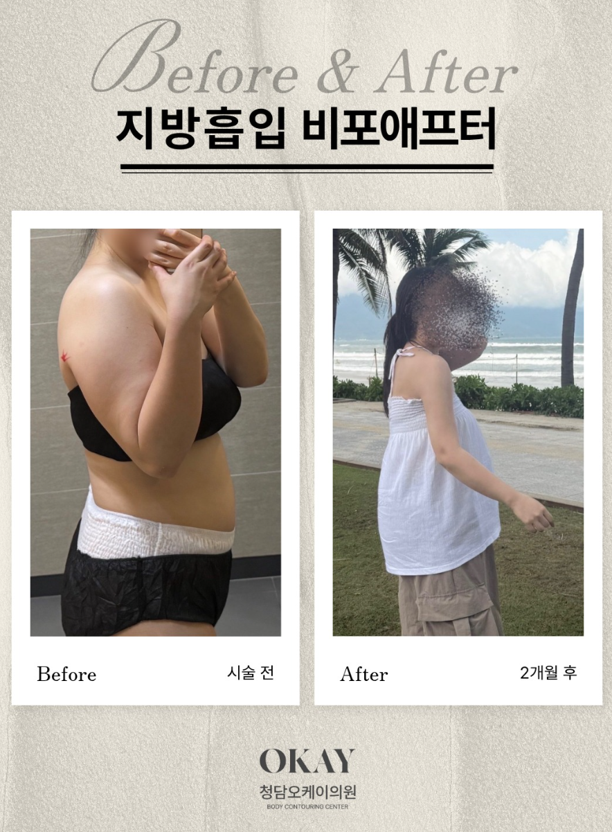 압구정다이어트, 지방흡입 후 다시 살찌면 원래대로 돌아갈까요? 관련 이미지 7