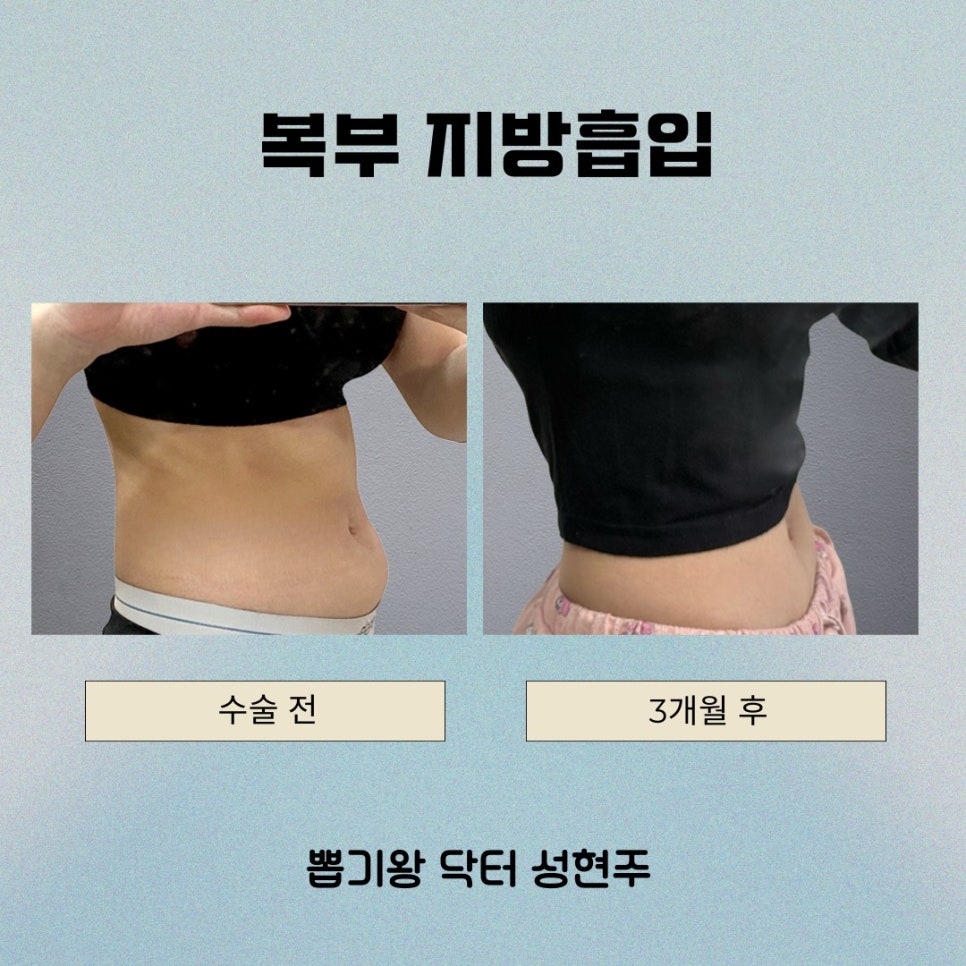 옆구리지방흡입, 허리라인 디자인이 중요한 이유 관련 이미지 4