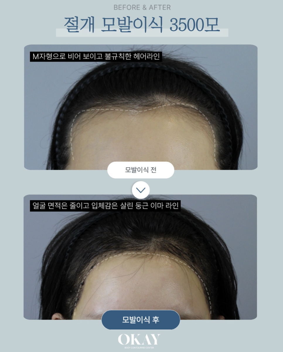 서울앞머리모발이식, 얼굴이 작아 보이는 헤어라인의 비밀 관련 이미지 2
