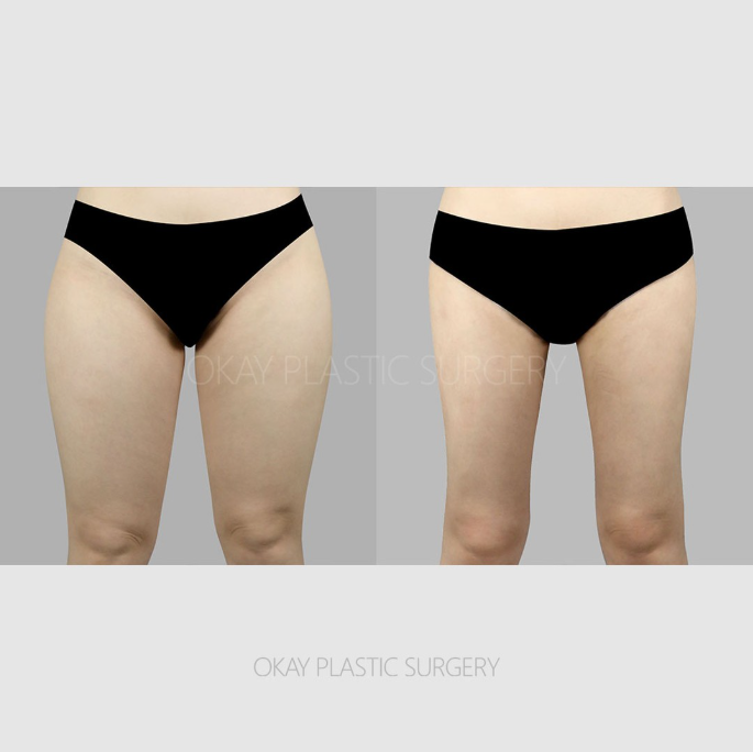 허벅지지방흡입후관리 어떻게 해야 할까? 붓기&middot;압박복&middot;회복기간 기준 정리 관련 이미지 4