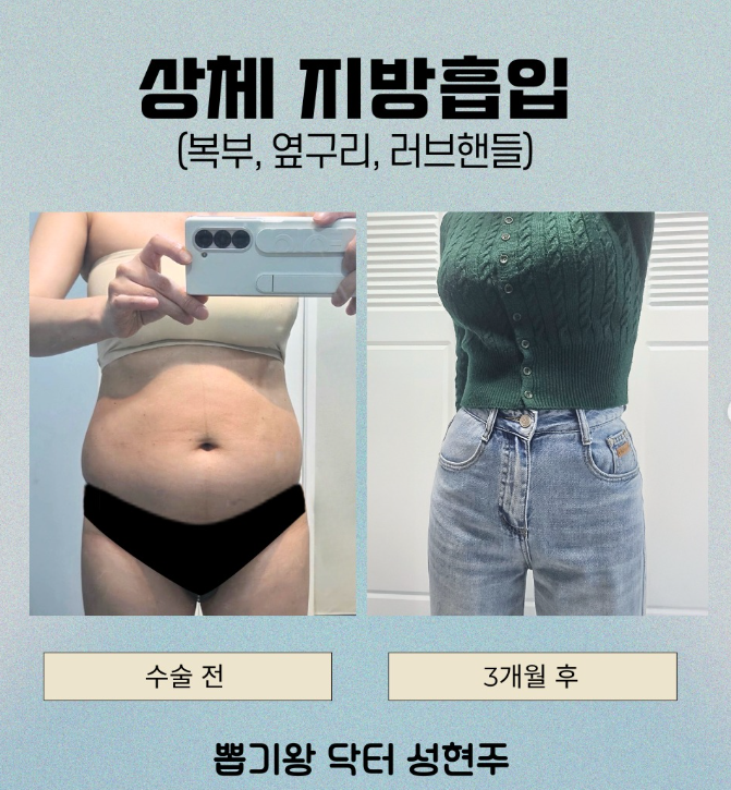 지방흡입 재수술, 처음보다 더 신중해야 하는 이유 관련 이미지 9