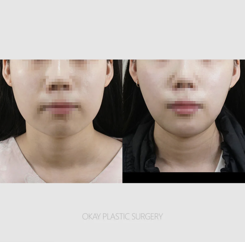 얼굴지방흡입 붓기/가격/후기/효과, 실제 후기에서 자주 등장하는 이야기들 관련 이미지 10