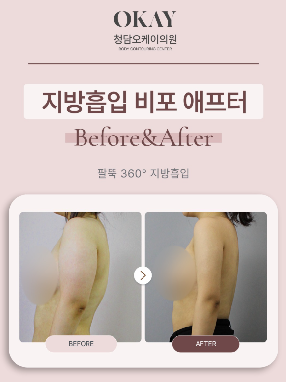 팔뚝지방흡입수술비용, 겨드랑이·부유방까지 하면 얼마나 달라질까? 관련 이미지 3