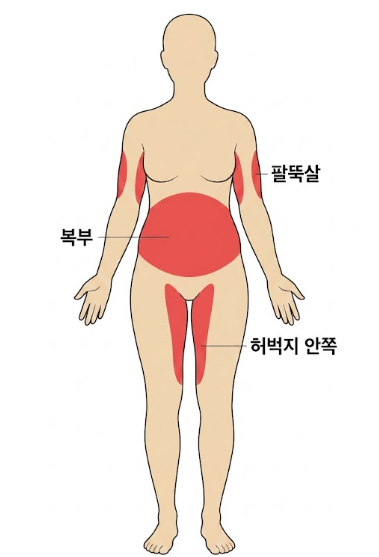 전신지방흡입후기, 수술시간부터 간격&middot;비용까지 꼭 알아야 할 것은? 관련 이미지 3