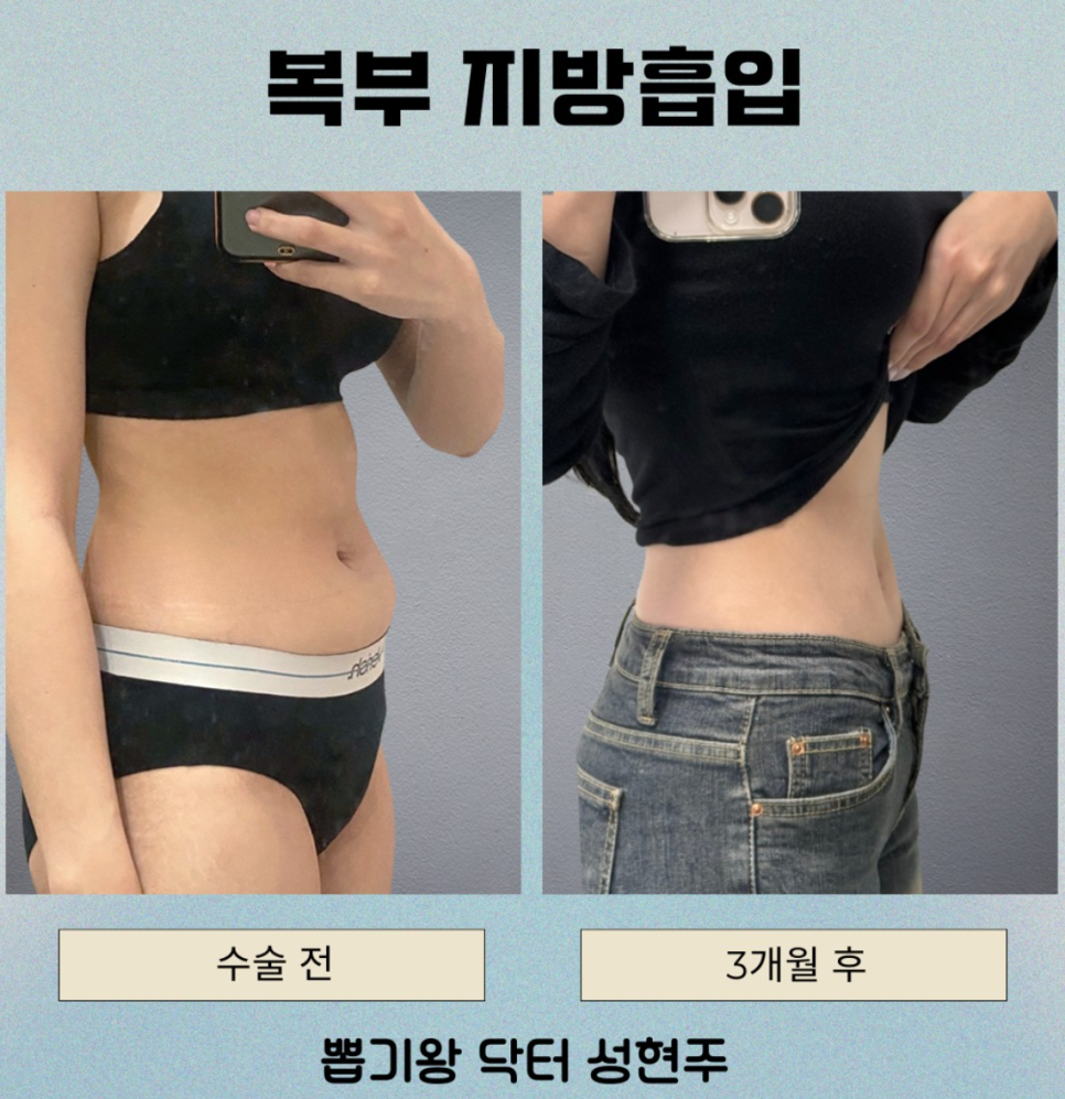 신사역성형외과, 뱃살&middot;팔뚝살 지방흡입으로 얼마나 줄일 수 있을까요? 관련 이미지 6