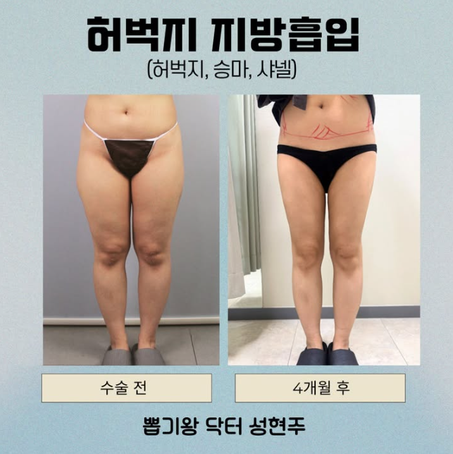 What Are the Liposuction Surgery Methods in Gangnam? A Summary of Procedure Types and Differences image 7