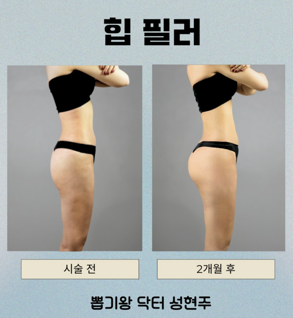 엉덩이필러 효과, 힙딥 개선은 어떻게 진행될까요? 관련 이미지 10