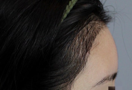 Why Results End Up Bad After Finding a ‘Hair Transplant Hotspot’ Clinic in Seoul: This Is Where It Comes Down to the Details image 13