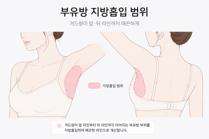 How Long Is the Recovery Period After Axillary Breast Tissue Liposuction? Summary of Return-to-Daily-Life Criteria image 3