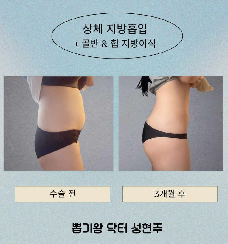 Buttock Fat Grafting: What Makes the Difference in Improving Fat-Graft Retention? image 6