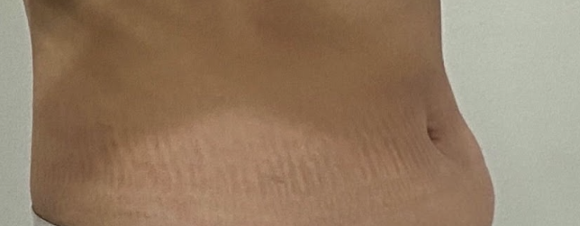 지방흡입수술방법, 허벅지와 복부가 다른 이유는? 관련 이미지 8
