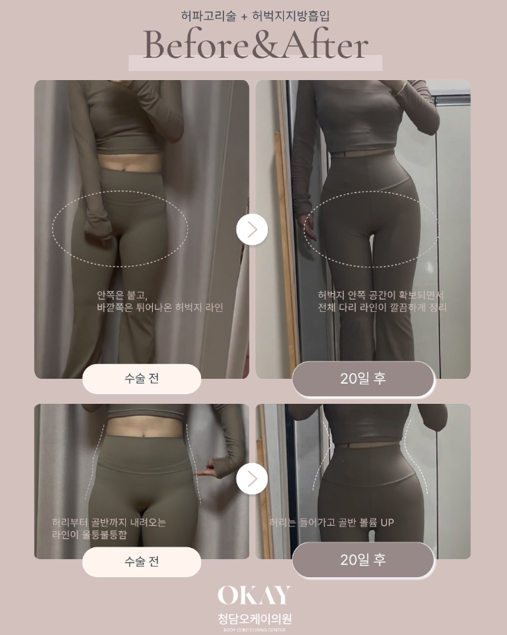허벅지지방흡입가격, 부위와 범위에 따른 차이 설명드립니다 관련 이미지 8