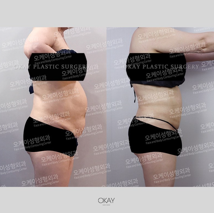 복부지방흡입가격, 비용보다 먼저 봐야 할 복부 라인의 차이 관련 이미지 6